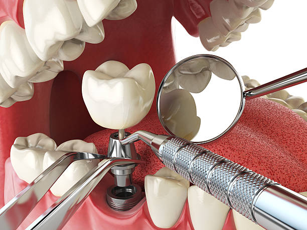 Best Emergency Wisdom Teeth Removal in Cloverdale, IN